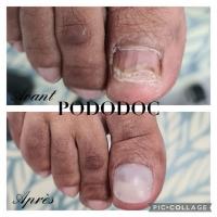 Ne souffrez plus de l'aspect inesthétique d'un ongle en testant les onychoplasties ou faux ongles, que nous réalisons sur mesure au cabinet Podo&Doc