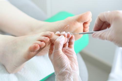 Orthèse ongle Montreuil Orthèse ongle Montreuil