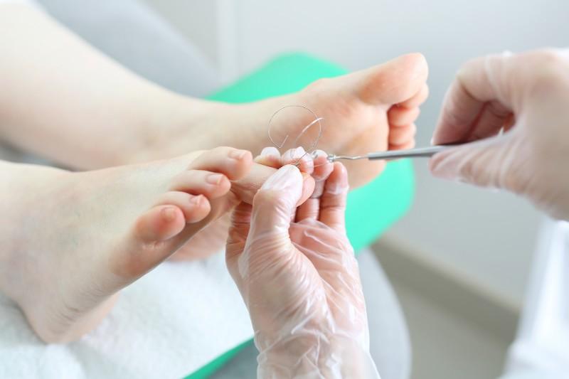Orthèse ongle Montreuil Orthèse ongle Montreuil